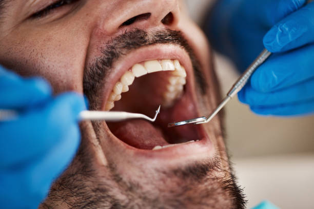 Best Emergency Tooth Extraction in Union, SC