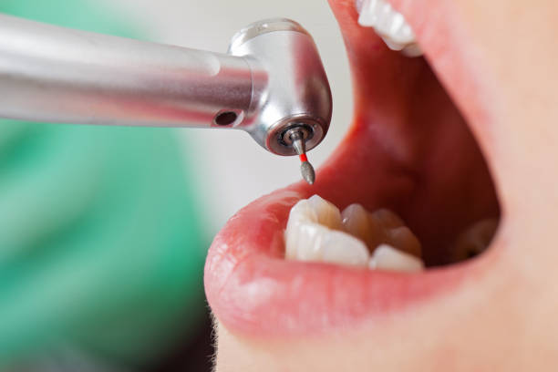 Best Emergency Broken Tooth Repair in Union, SC